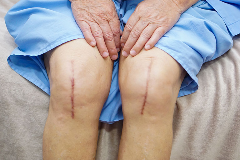 Post Surgery Image - 2 knees with surgical scars.